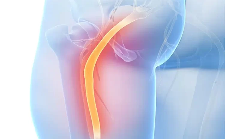  Understanding Sciatica: Causes, Symptoms, and Treatment Options