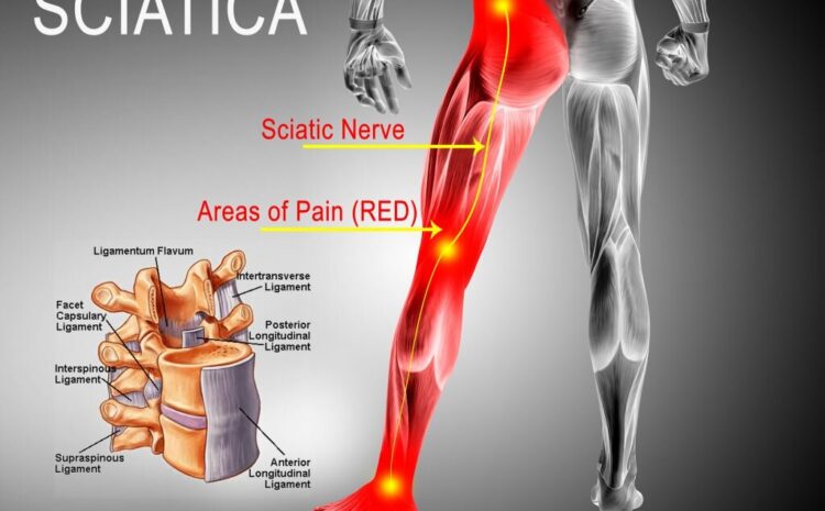  Finding Lasting Relief for Sciatica in Shreveport